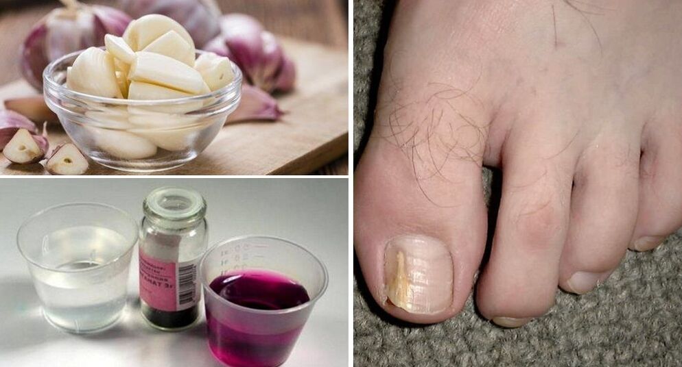 prevenirea ciupercii picioarelor și unghiilor cu oțet)